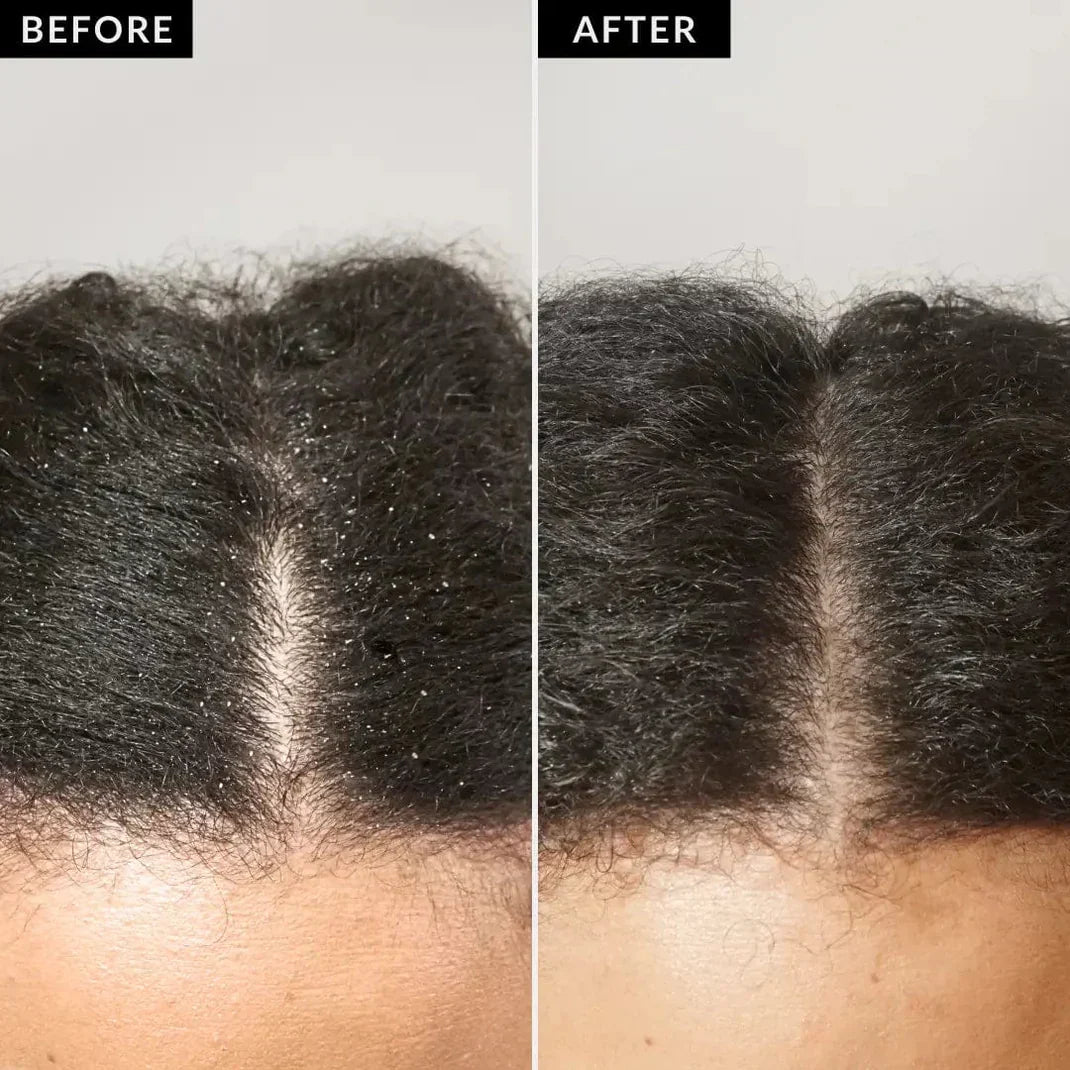 1+1 I FREE Dandruffree™ Scalp Detox Comb