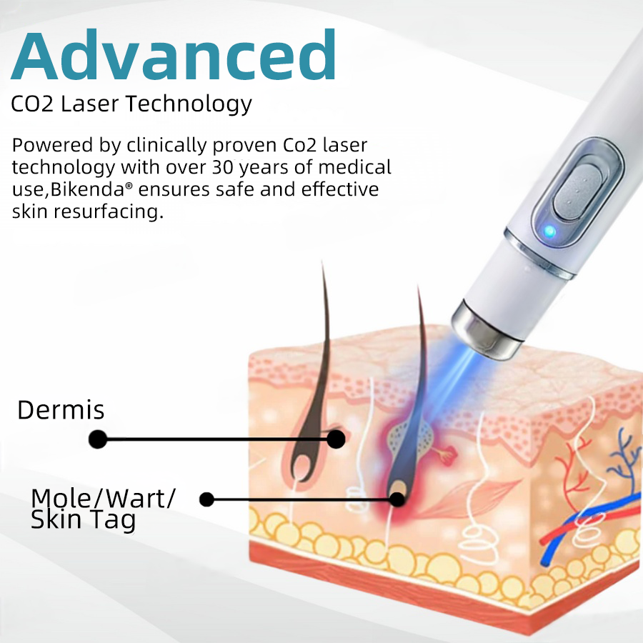 Molde® Non-Invasive Mole and Wart Removal Laser Pen Promax