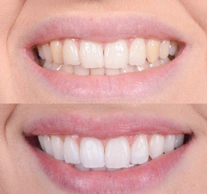 1+1 FREE | Smiley™ - Teeth Whitener