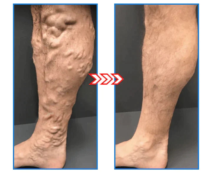 1+1 Free | IoniSocks™ - Slim legs and firm skin in one step!