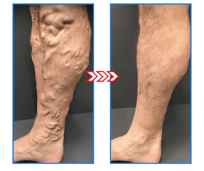 1+1 Free | IoniSocks™ - Slim legs and firm skin in one step!