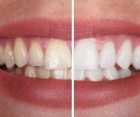 1+1 FREE I SmileKit™ | Feel more confident with a fresh, radiant smile that lasts