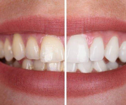 1+1 FREE I SmileKit™ | Feel more confident with a fresh, radiant smile that lasts